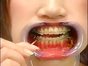 Japanese girl with braces and cheek retractors