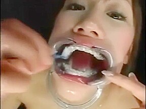 Japanese girl with braces and cheek retractors