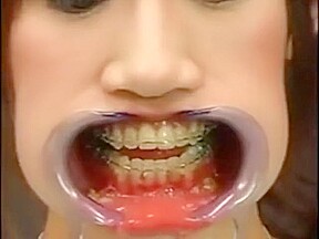 Japanese girl with braces and cheek retractors