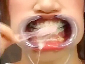Japanese girl with braces and cheek retractors