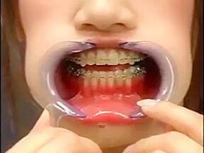 Japanese girl with braces and cheek retractors