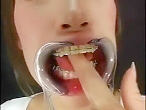 Japanese girl with braces and cheek retractors