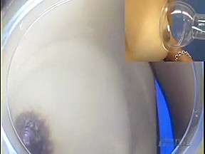 Vacuuming Breast Enlargement